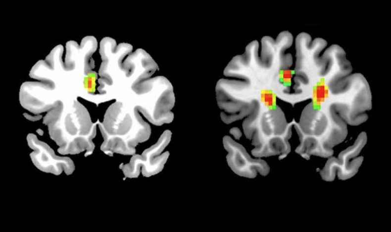 Αριστερά η απεικόνιση στο scan ενός μη ερωτευμένου εγκεφάλου και δεξιά η ανάλογη εικόνα όταν το άτομο είναι ερωτευμένο
