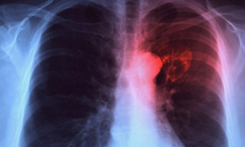 Η φυματίωση ξαναείναι εδώ, με περίπου 600 νέα περιστατικά τον χρόνο. Η φυματίωση βρίσκεται σε παγκόσμια έξαρση
