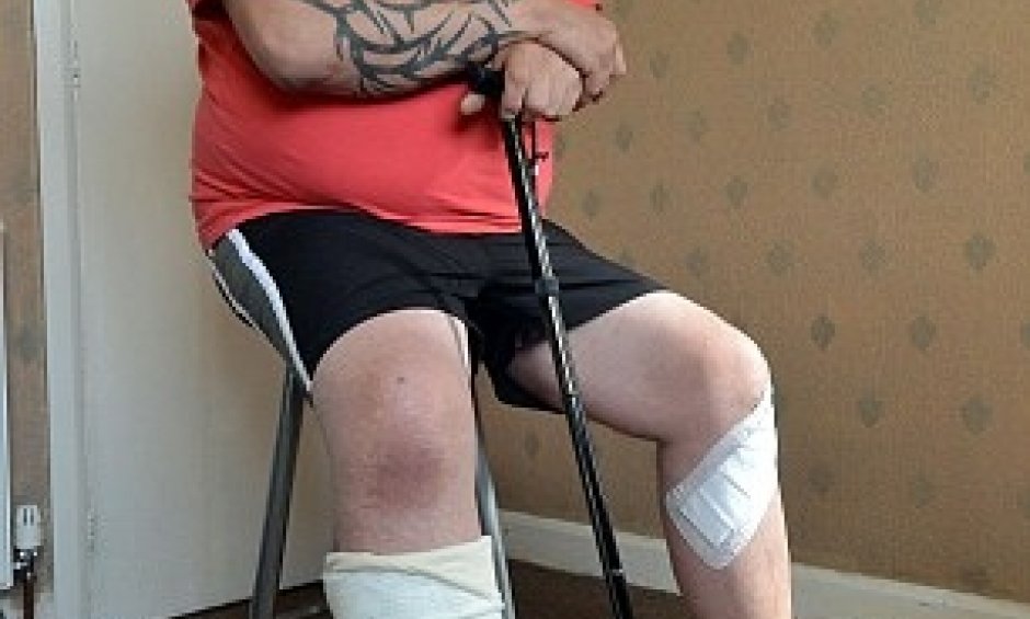 Μεγάλη Βρετανία: Κι άλλο σοβαρό περιστατικό με έκρηξη ηλεκτρονικού τσιγάρου