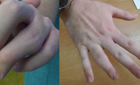 Στοπ στις αναπηρίες δακτύλων βάζει πλέον η μικροχειρουργική
