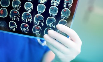 Νέο φάρμακο μειώνει σημαντικά την ατροφία εγκεφάλου σε ασθενείς με Πολλαπλή Σκλήρυνση