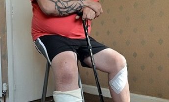 Μεγάλη Βρετανία: Κι άλλο σοβαρό περιστατικό με έκρηξη ηλεκτρονικού τσιγάρου