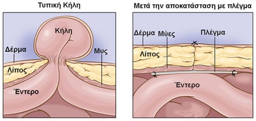 Τι είναι η κήλη;