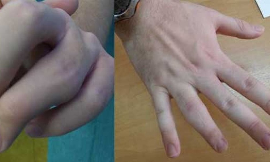 Στοπ στις αναπηρίες δακτύλων βάζει πλέον η μικροχειρουργική