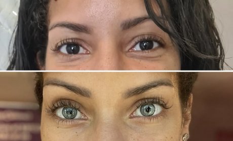 Πρώτη επιτυχημένη επέμβαση στην Ελλάδα αλλαγής χρώματος οφθαλμών