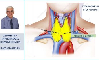 Καταδυόμενη βρογχοκήλη – τι είναι και πώς αντιμετωπίζεται?