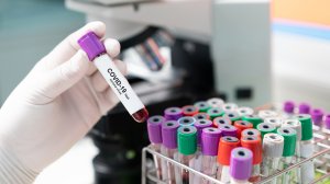 Δωρεάν εξέταση αντισωμάτων COVID-19 για το προσωπικό των σωμάτων ασφαλείας σε Αττική και Θεσσαλονίκη