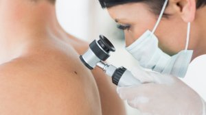 Όλα όσα πρέπει να γνωρίζετε για το δερματικό μελάνωμα