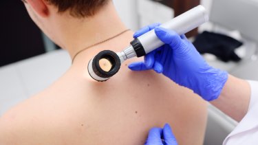 melanoma