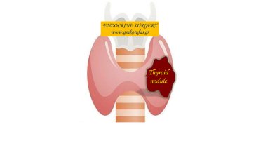 thyroid-nodule