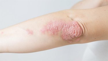 105604-psoriasielbow1280