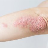105604-psoriasielbow1280